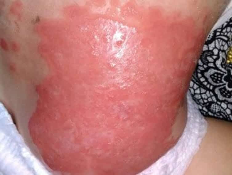 huidaandoening Staphylococcal scalded skin syndroom (SSSS)